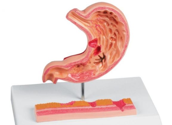 https://jayakelana.id.202-10-43-6.cpanel.site/uploads/product/-k217-stomach-with-ulcers-69392f48960fe9e_cover.jpg