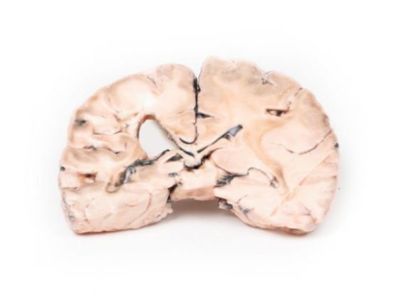 https://jayakelana.id.202-10-43-6.cpanel.site/uploads/product/-mp2005-left-cerebral-infarct-79391d7c5ffe427_cover.jpg