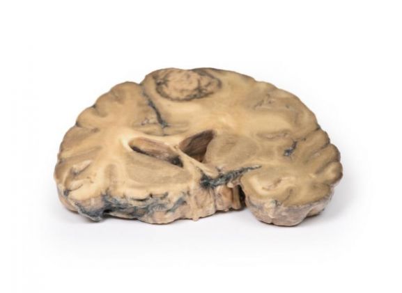 https://jayakelana.id.202-10-43-6.cpanel.site/uploads/product/-mp2007-metastatic-adenocarcinoma-in-681531e669e5ea8_cover.jpg